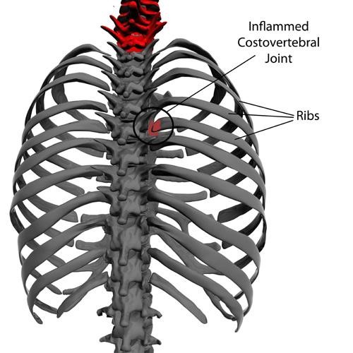 Rib Pain Causes And Treatments West Des Moines IA