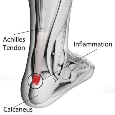 Achilles Tendon Injuries West Des Moines IA | Achilles Tendonitis