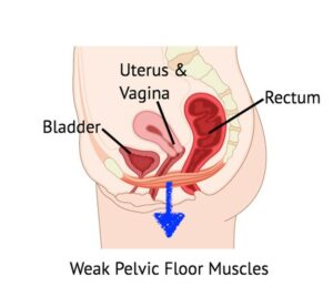 Weak Pelvic Floor Muscles