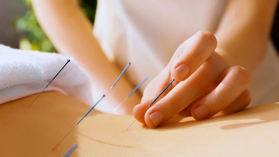 Acupuncture Therapy in Urbandale, IA