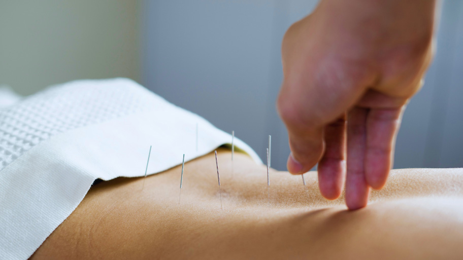 Acupuncture Therapy in Des Moines, IA